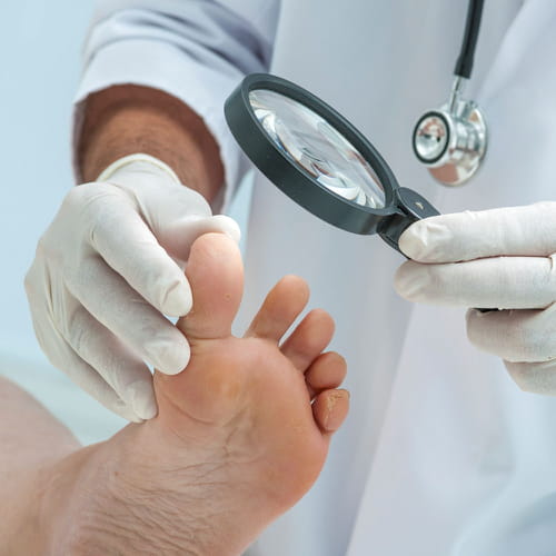 Distruzione di un fungo su unghie di gambe