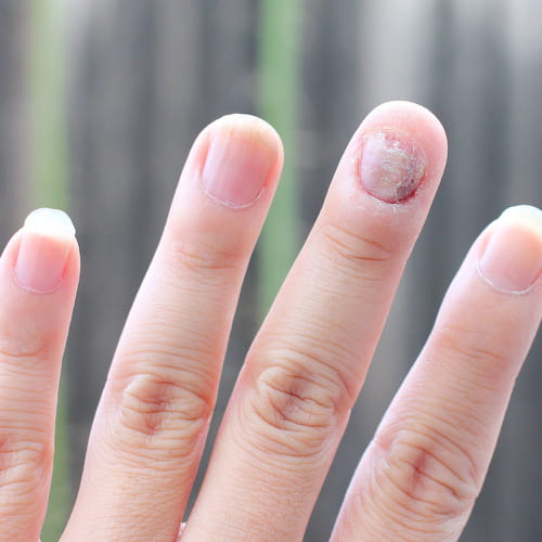 Unghie bianche cause e sintomi